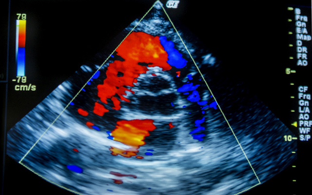 ультразвукове дослідження серця