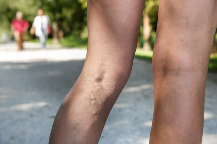 Варикозное расширение вен